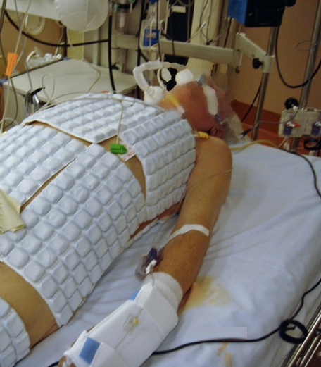 Me on day 1 in ICU after dive accident